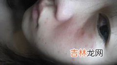 脸上为什么长闭口,脸上长闭口是什么原因怎样去掉