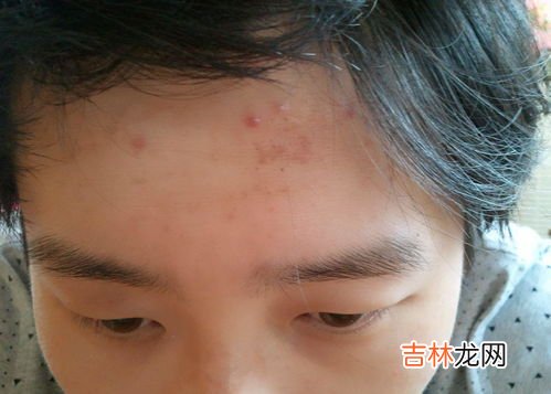 男性长痘痘是因为什么,男人为什么脸上会长豆豆?