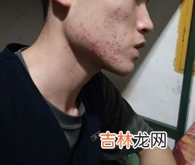 男性长痘痘是因为什么,男人为什么脸上会长豆豆?