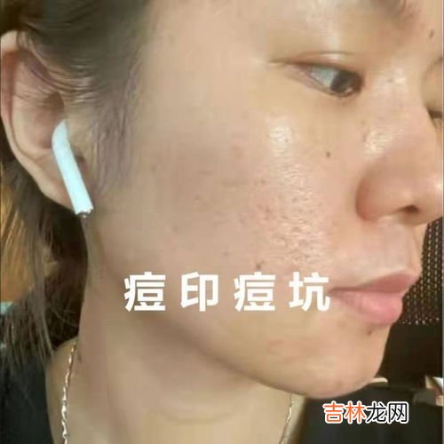 男性长痘痘是因为什么,男人为什么脸上会长豆豆?