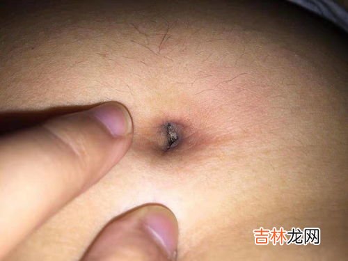 肚脐眼黑是因为什么,为什么我的肚脐眼里有很多黑黑的东西？