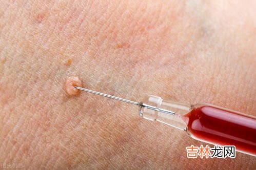 抗hpv乳球蛋白小分子肽冷敷凝胶用了有什么反应,臻谧凝胶该如何使用？有什么反应？有哪些注意事项？