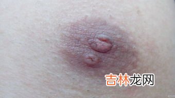 为什么乳头是裂开的,乳头皲裂是什么原因