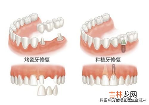 为什么牙科这么贵,做牙齿为什么这么贵？