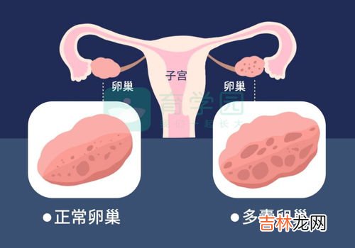 为什么突然得多囊卵巢,女性肥胖、长痘、多毛是多囊的表现吗？多囊的危害有什么？