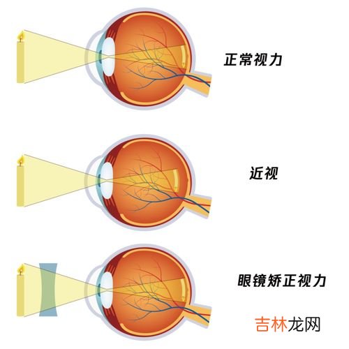 为什么近视度数涨得快,为什么孩子近视度数增长那么快？两年的时候去检查涨了200度。