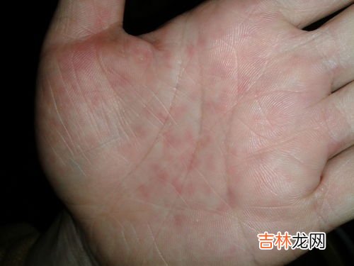 为什么手突然很痒,手指莫名其妙的痒是怎么回事