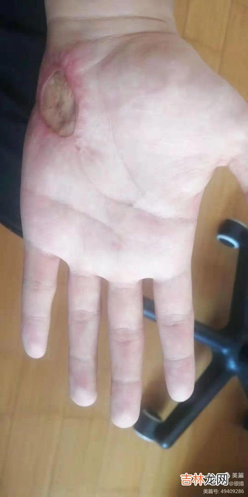 为什么会得筋膜炎,什么是筋膜炎?筋膜炎上身时,哪些地方会感觉到疼痛?