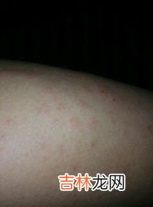 为什么皮肤老是痒,为什么皮肤会无缘无故的痒