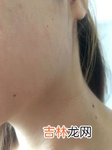 为什么长生长纹,为什么胸上有生长纹？