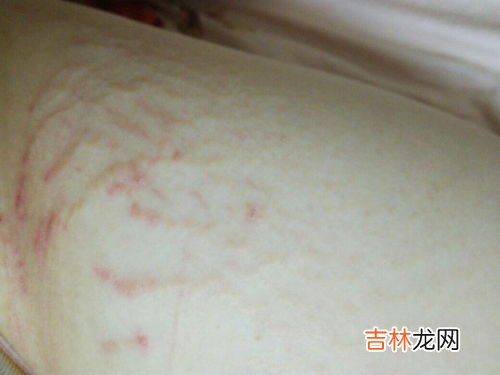 为什么长生长纹,为什么胸上有生长纹？