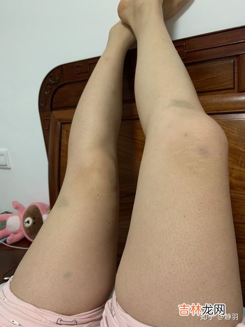 为什么身上有淤青,身上莫名有一块淤青是怎么回事？