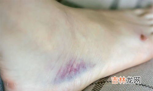 为什么身上有淤青,身上莫名有一块淤青是怎么回事？