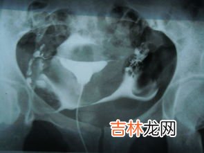 输卵管造影为什么出血,月经三天后去做的输卵管造影做完后三四天出血量很大
