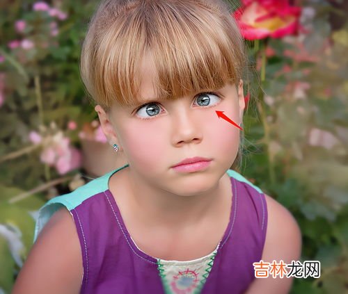 眼睛突然斜视了为什么,斜视是什么原因造成的?斜视的原因