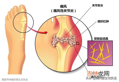 清酸华方能治好痛风吗,全酸清可以治疗痛风吗？效果怎么样