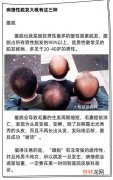 青春期为什么会掉头发,青少年掉头发是什么原因？