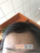 为什么额头老是长痘怎么办,额头上长痘痘怎么办 额头上长痘痘的原因