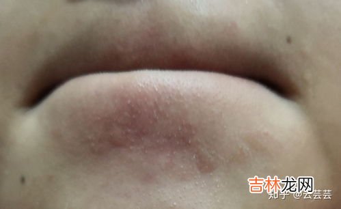 去黑头药膏怎么用法,去黑头药膏怎么用法