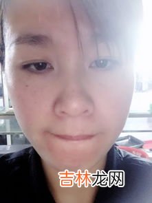 为什么鼻子两边总是长痘痘,鼻翼两边长痘是什么原因