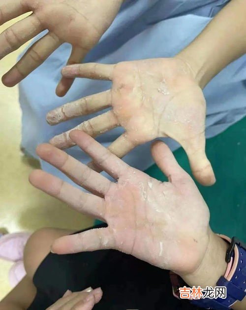 502粘住手了怎么处理,502胶水粘手上怎么去除?