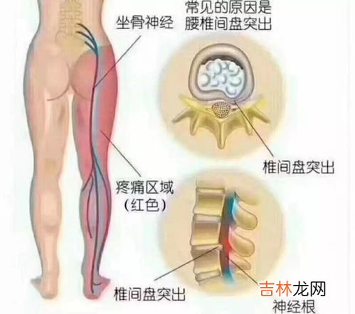 为什么坐骨神经痛,坐骨神经痛是怎么引起的？