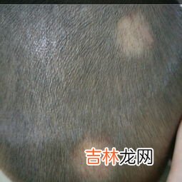 人为什么会长癣是什么原因,为啥皮肤会常常长皮癣，怎么办？已经很注意个人卫生了!