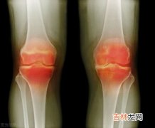 关节宝有什么功效,腰椎间盘突出吃法-国关节宝有什么功效呢