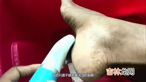 为什么脚后跟会痒,脚后跟痒还红肿?